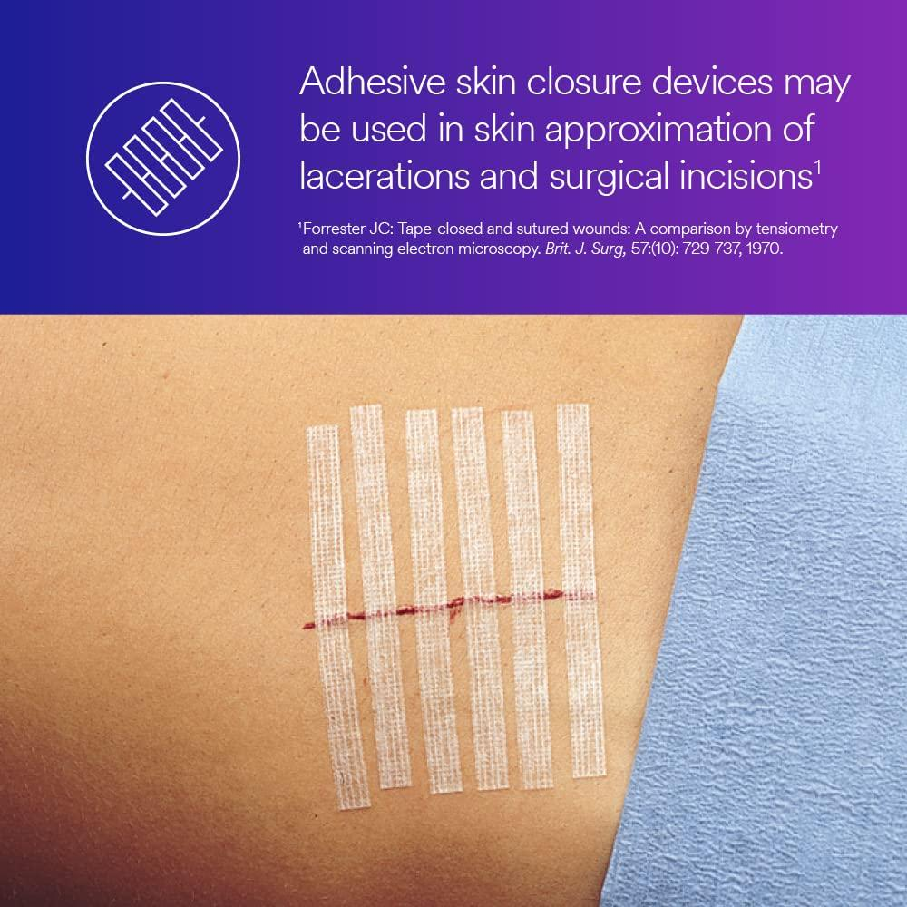 <p>Strips applied over a wound or incision line to help support sutures and keep wound edges together.</p><ul><li><p><span>They lift away cleanly with minimal residue and are designed for minor cuts and lacerations.</span></p></li></ul><p></p>