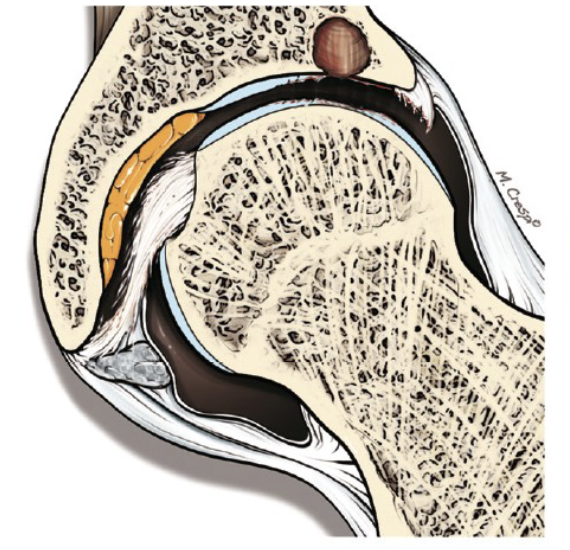 <p>What condition of the ligamentum teres is shown</p>