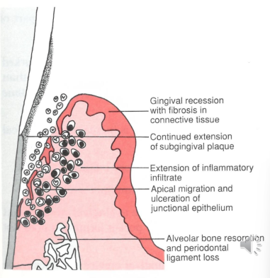 <p>deepening of the inflammation causes loss of the pdl attachemnt and andveolar bone resorption </p><p>apical migration of the junctional epithelium - causing deepening of the pocket </p>
