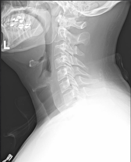 <p>Is this film of diagnostic quality (Lateral Cervical)</p>