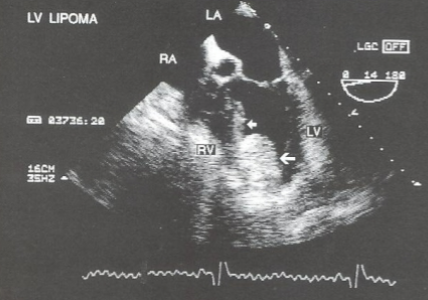 <ul><li><p>neoplasm of mature fat cells</p></li><li><p>well-defined, homogenous, dense mass</p></li><li><p>can invade all 3 heart layers</p></li></ul><p></p>