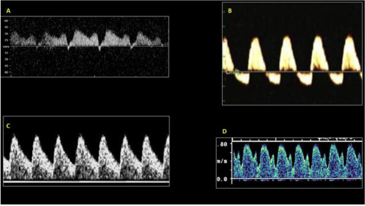 <p>Which of the waveforms above is a normal ductus venosus waveform?</p>