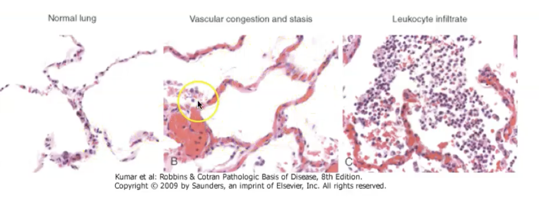 <ul><li><p>The cellular and vascular changes that characterise acute inflammation are reflected in the morphologic appearance of the reaction.</p><ul><li><p>Severity.</p></li><li><p>Specific cause</p></li><li><p>Tissue type.</p></li></ul></li></ul><p></p><p>The morphology of acute inflammation is characterised by <strong>vascular dilation</strong>, leading to redness and warmth; <strong>increased vascular permeability</strong>, producing protein‑rich <strong>exudate</strong> and tissue <strong>oedema</strong>; and <strong>neutrophil‑rich infiltration</strong> into the affected tissue. Early on, you see <strong>congestion</strong> of dilated vessels, followed by <strong>fibrin deposition</strong>, <strong>neutrophil accumulation</strong>, and sometimes <strong>necrosis</strong> of surrounding tissue. Depending on the cause, acute inflammation may appear as <strong>serous</strong>, <strong>fibrinous</strong>, <strong>suppurative (pus‑forming)</strong>, or <strong>ulcerative</strong> patterns. These morphological patterns reflect the intensity and type of injury and help pathologists identify the underlying process.</p>