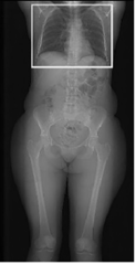 <p>Start location: Just below lowest hemidiaphragm End location: Lung apices (scans are inferior to superior)</p>