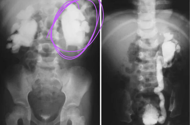 <p>Distention of the renal pelvis and calyces of the kidneys that results from some obstruction of the ureters or renal pelvis.</p>