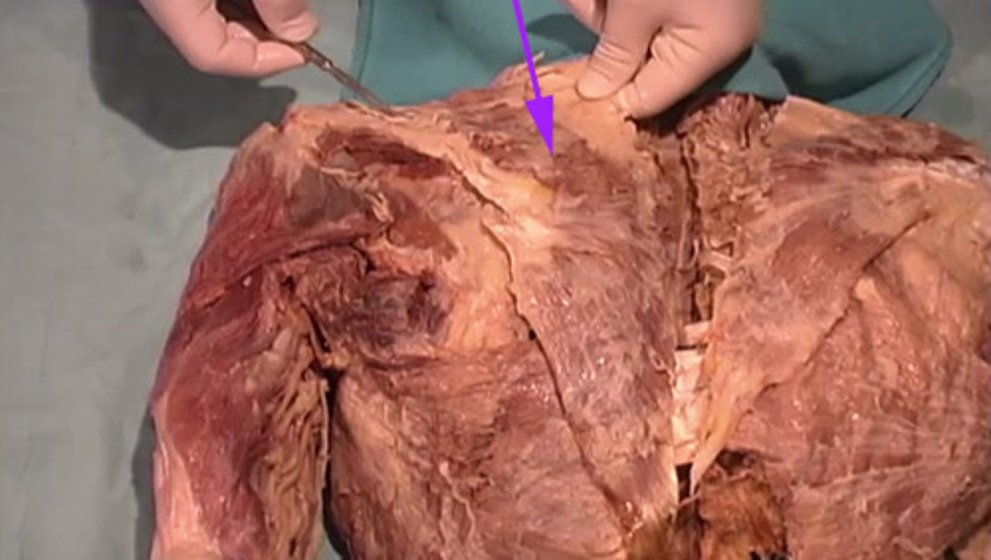 <p>Which muscle is indicated by the arrow?</p>