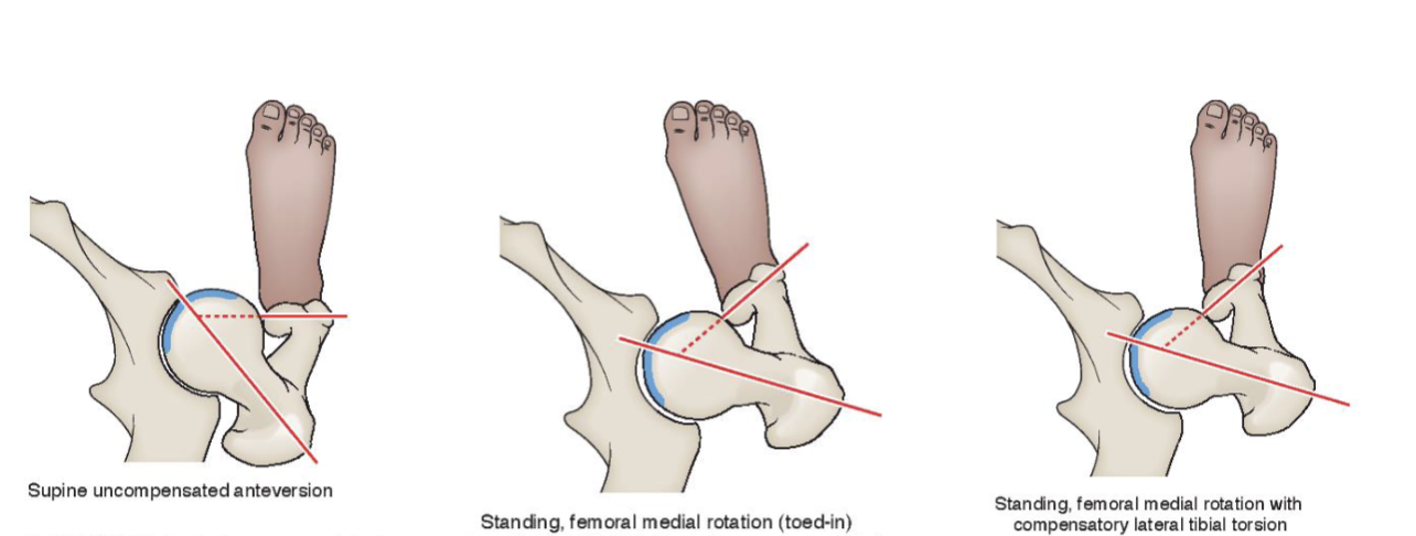 <p><strong>Supine uncompensated anteversion: </strong></p><ul><li><p>hyaline cartilage (blue) more exposed anteriorly</p></li><li><p>unstable in front of hip </p></li></ul><p></p><p><strong>Standing femoral medial rotation (toed-in):</strong></p><ul><li><p>to get less of blue to be exposed</p><ul><li><p>IR of femur → decrease anteversion + more covered acetabulum</p></li><li><p>patellas will face medially</p></li></ul></li></ul><p></p><p><strong>Standing femoral medial rotation w/ compensatory lateral tibial torsion:</strong></p><ul><li><p>overtime, there will be compensatory lat/ext torsion of tibia</p><ul><li><p>allowing for feet to be pointed straight ahead</p></li></ul></li></ul><p></p>