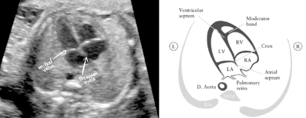 <ul><li><p>make note of right and left side</p></li><li><p>lung should be seen on both sides of the heart</p></li><li><p>ensure no fluid or masses seen adjacent to/around the heart</p></li><li><p>LA is closest to AO and spine</p></li><li><p>foramen ovale opens between RA and LA</p></li><li><p>note symmetry between atria and ventricles</p></li><li><p>tricuspid valve is on right side (b/w RA and RV) </p></li><li><p>bicuspid/mitral valve is on left side (b/w LA and LV)</p></li></ul><p></p>