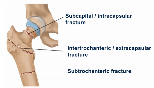 <p>Subcapital (intracapsular), intertrochanteric, subtrochanteric</p>