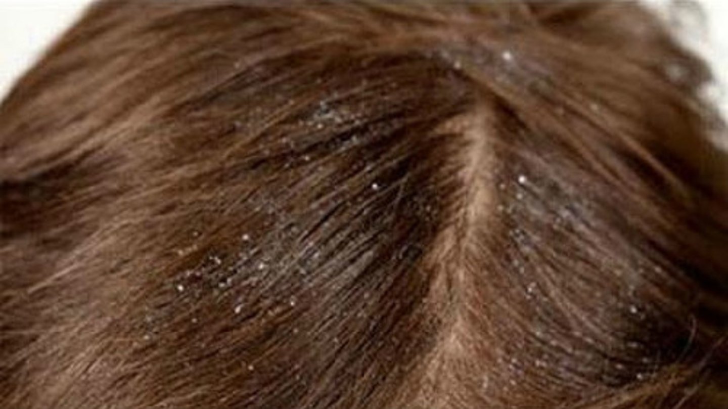 <p>dandruff</p>