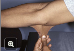 <p>hyper-extensible joints, skin or vascular aneurysms</p>