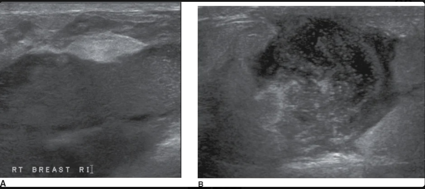 <p>The masses in image were discovered in lactating patient who were suffering from focal breast erythema, swelling, fever, &amp; rain. What is the most likely diagnosis</p>