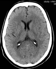 <p>a series of X-ray photographs taken from different angles and combined by computer into a composite representation of a slice of the brain's structure. (Also called CAT scan.)</p>