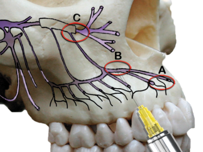 <p>What kind of injection is being done at C?</p>