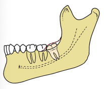 <p>usually easiest</p><p>tooth covered only by soft tissue</p><p><span style="color: red;">requires incision & flap reflection</span></p>