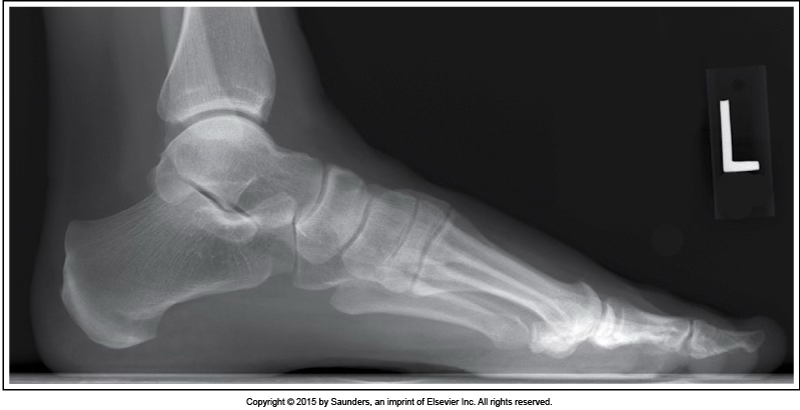 <p>lateral foot</p>