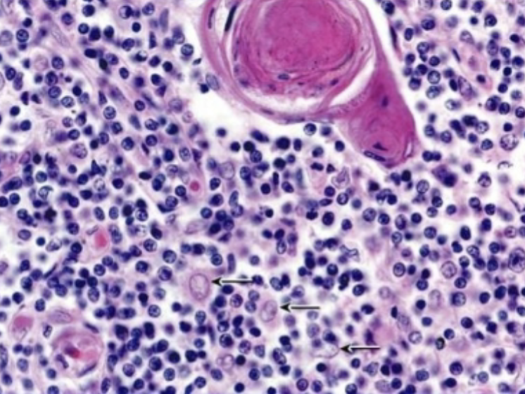 <p>What is that big ol eosinophilic thing?</p>
