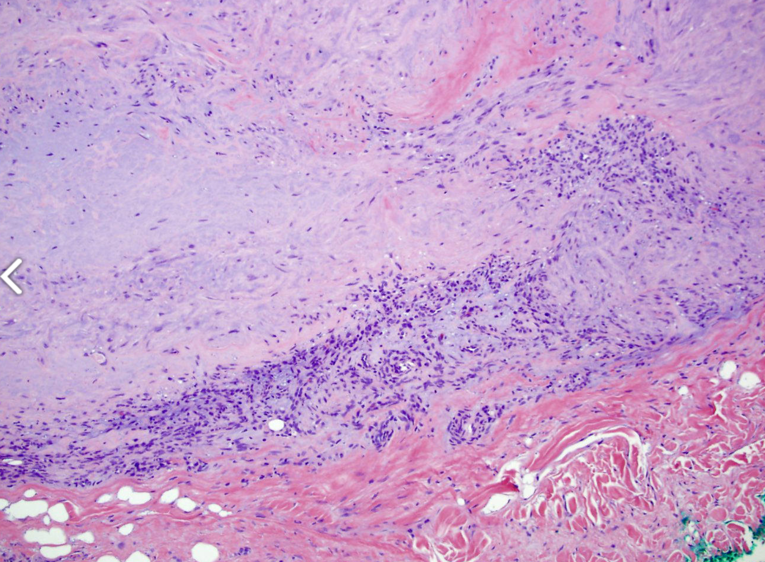 <p>tumeur dermique du pied (aspect hémangiopéricytaire au centre)</p><p>1) diagnostic</p><p>2) morphologie</p><p>3) IHC</p><p>4) moléculaire </p><p>5) localisation </p>