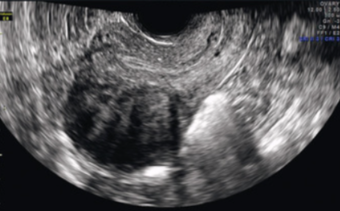 <p>Name the type of fibroid and its location</p>