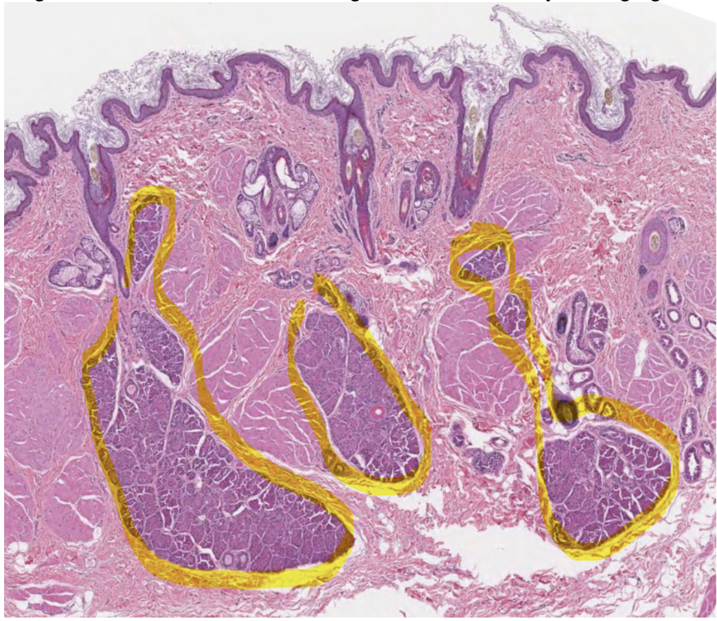 <p>What is highlighted in yellow in this anal sac?</p>