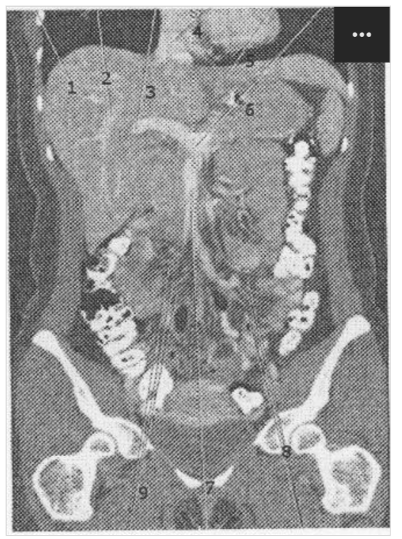 <p><span>1 Which of the following represents the left lobe of the liver?</span></p><p><span>2 Which represents the right main portal vein?</span></p>