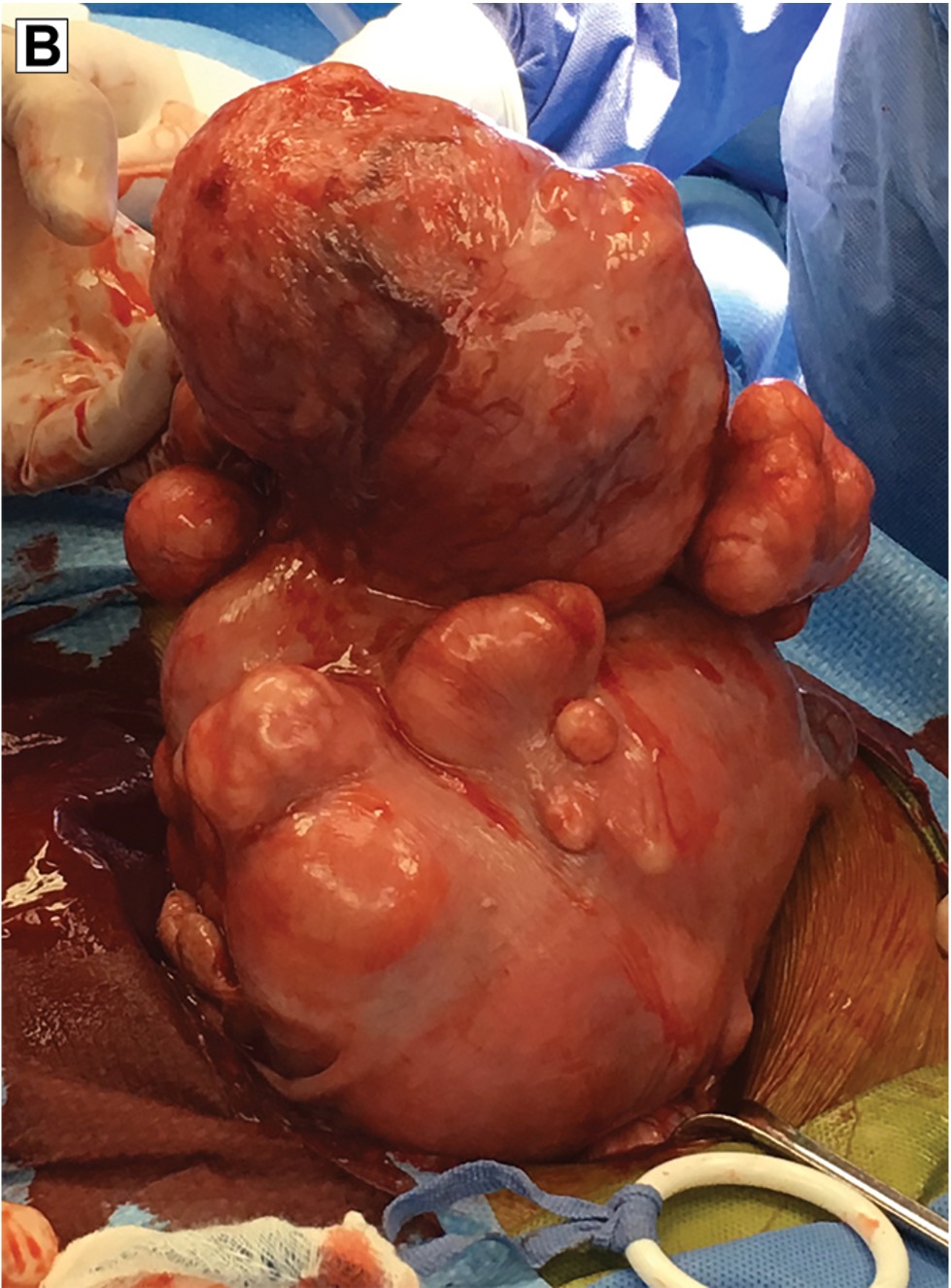 <p>small raised bumps under skin or serosa</p>
