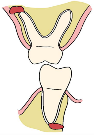 <p>Periapical infections arising from maxillary molars generally erode through the thin buccal cortex.</p><p>Periapical infections arising from mandibular molars generally erode through the lingual cortex.</p>