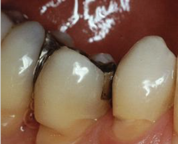 <p>occlusal stress</p>