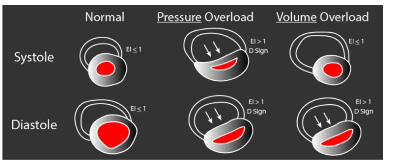 <p>a D-shaped ventricle in diastole suggests RV volume overload</p>