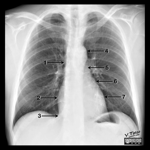 <p>1: SVC<br>2: Right atrium<br>3: IVC<br>4: Aortic arch<br>5: Main pulmonary artery<br>6: Left atrial appendage<br>7: Left ventricle</p>