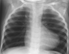 <p>CXR finding of TOF</p>