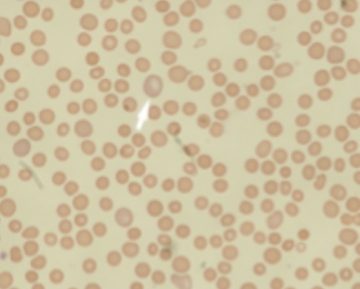 <ul><li><p>Haemolysis, </p></li><li><p>spherocytes on blood film </p></li><li><p>possible family history.</p></li></ul><p></p>