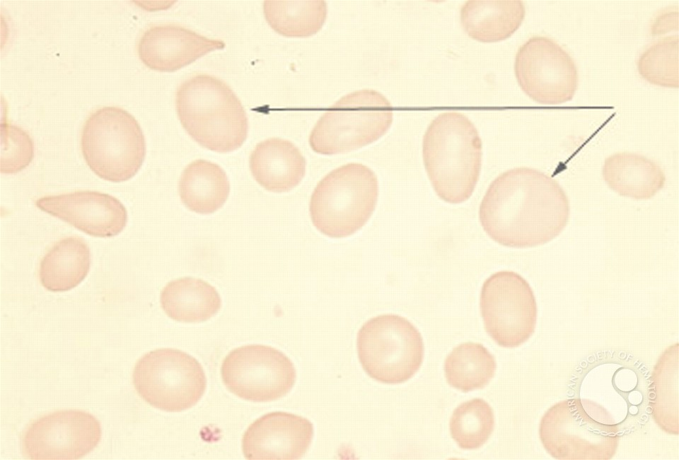 <p>Myelodysplastic syndrome; thalassemic syndromes; megaloblastic processes. Ovalocytes may be macrocytic.</p>