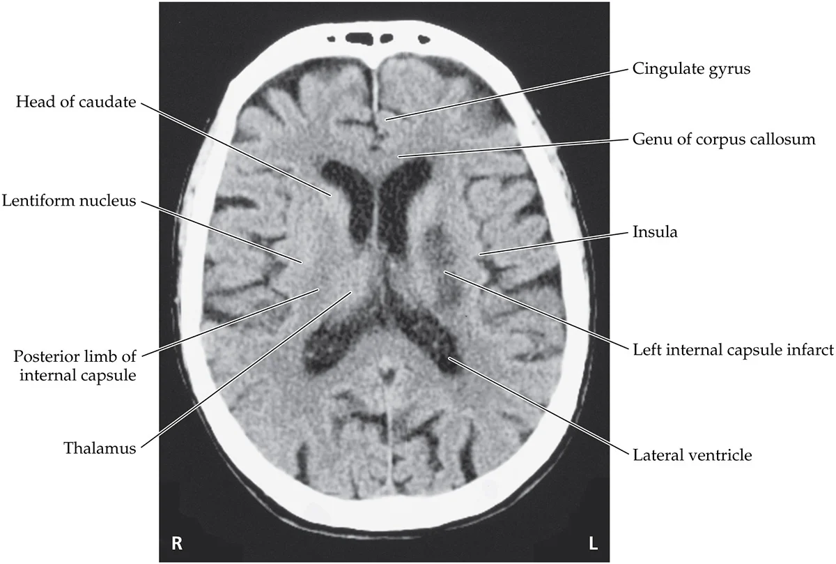 <p>Internal capsule infacts, occlusion of lenticulostriate arteries. MCA</p>