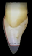 <p>What kind of incisal reduction is this</p>
