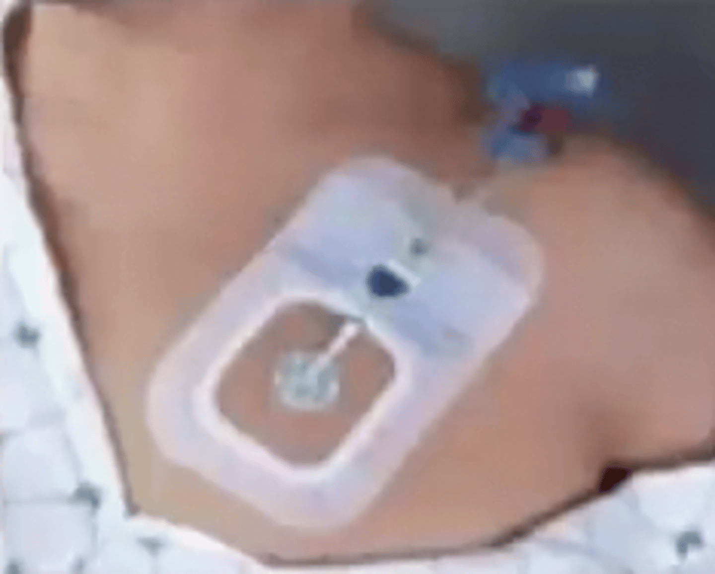 <p>measures blood pressure directly from right atrium and superior vena cava</p>