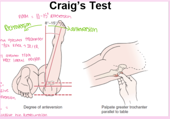 <ul><li><p><strong>Purpose:</strong> Assesses <strong>femoral anteversion or retroversion</strong>.</p></li><li><p><strong>How:</strong> Patient prone with the <strong>knee flexed to 90°</strong>. Palpate the <strong>greater trochanter</strong> while internally and externally rotating the hip until the trochanter is <strong>most prominent laterally</strong>, then estimate the angle.</p></li><li><p><strong>Positive:</strong></p><ul><li><p><strong>Anteversion >15°</strong> (commonly <strong>30–35°</strong>) → <strong>excessive femoral anteversion</strong></p></li><li><p><strong>≈0° or external rotation</strong> → <strong>femoral retroversion</strong>.</p></li></ul></li></ul><p><strong>Clinical presentation:</strong></p><ul><li><p><strong>Excessive anteversion:</strong> <strong>Toeing-in</strong>, <strong>squinting patellae</strong>, <strong>>60° of hip internal rotation</strong>, and <strong>decreased external rotation</strong>.</p></li><li><p><strong>Retroversion:</strong> <strong>Decreased internal rotation</strong> and <strong>increased external rotation</strong>.</p></li></ul><p></p>