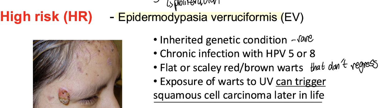 <p><strong><mark data-color="red" style="background-color: red; color: inherit;">Include HPV-5, HPV-8, and HPV-49. </mark></strong></p><ul><li><p>Associated with a <strong><u>higher probability of causing skin cancers and lesions</u></strong>. </p></li><li><p>Typically manifest clinically as the chronic infection, <strong><mark data-color="yellow" style="background-color: yellow; color: inherit;">EV - Epidermodypasia verruciformis </mark>→ can lead to squamous cell carcinoma due to UV exposure</strong></p></li><li><p>Contracted primarily due to a genetic disorder that <strong><u>increases susceptibility to HPVs</u></strong></p></li></ul><p></p>