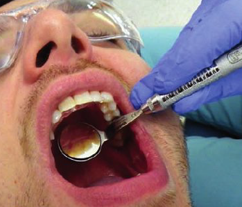 <ul><li><p>3 to 4 o’ clock position</p></li><li><p>Hold mirror in right hand, rest ring and pinkie on patient’s left cheek or premolar teeth </p></li><li><p>Swivel mirror head so lingual surfaces reflect towards you in the mirror</p></li></ul><p></p>