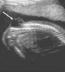 <p>What are we seeing in this image?</p><p>a. Myelomeningocele</p><p>b. Teratoma</p><p>c. Cystic hygroma</p><p>d. Brachial cleft cyst</p>