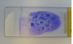 <p>» Ideally prepare/spread the smear as soon as possible after the sample is obtained.</p><p>» Wet fresh preparations smear more readily - otherwise if dry more likely to break the cells</p><p>» If in fluid cells may alter in vitro - so usually take fluid out cos cells can swell up cos osmosis, diff impression of what the cells acc look like in patient</p><p>» Consider if sending to a laboratory that automated stainers may not stain the entire smear</p>