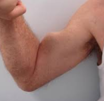 <p><span style="background-color: transparent;"><strong>What is the name of the injury shown in the picture below?</strong></span></p>