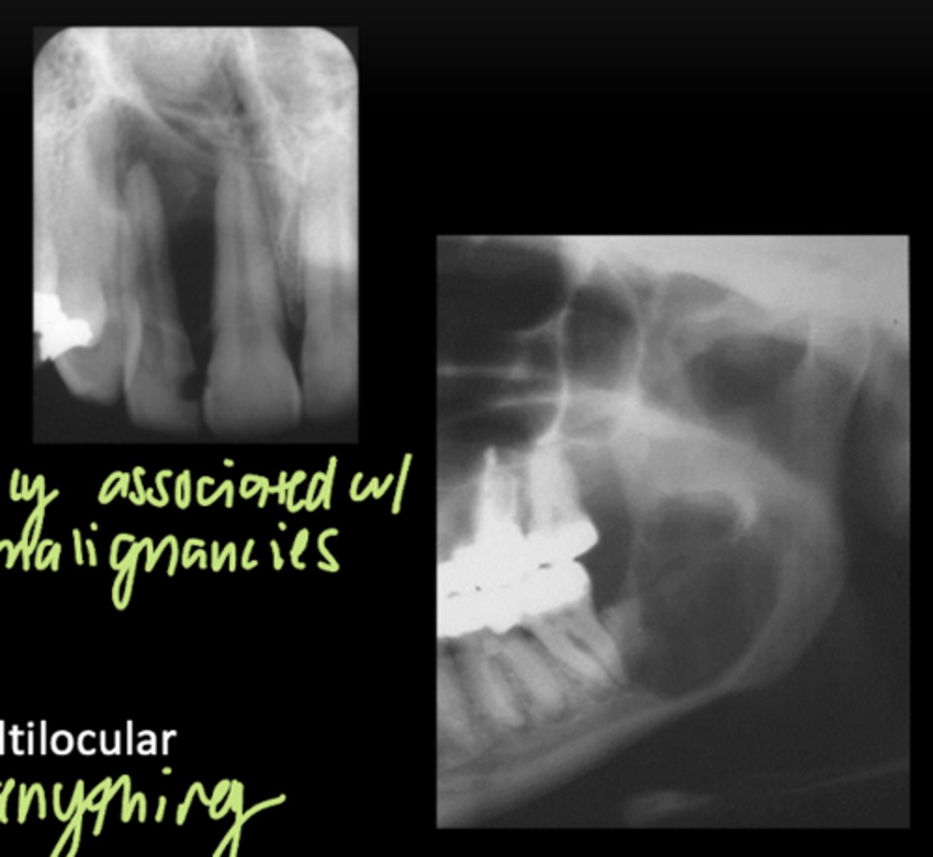<p>- Margins: well-defined or ill-defined</p><p>- Density: radiolucent</p><p>- Internal architecture: unilocular or multilocular</p>