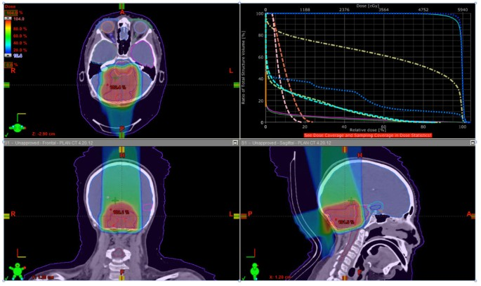 <p>B pharynx and spinal cord</p><div data-type="horizontalRule"><hr></div><p>When treating the vertex with the patient in neutral position, the vertex field would exit through the pharynx. If the patient is treated with chin flexed, the vertex field exits through the pharynx and spinal cord.</p>