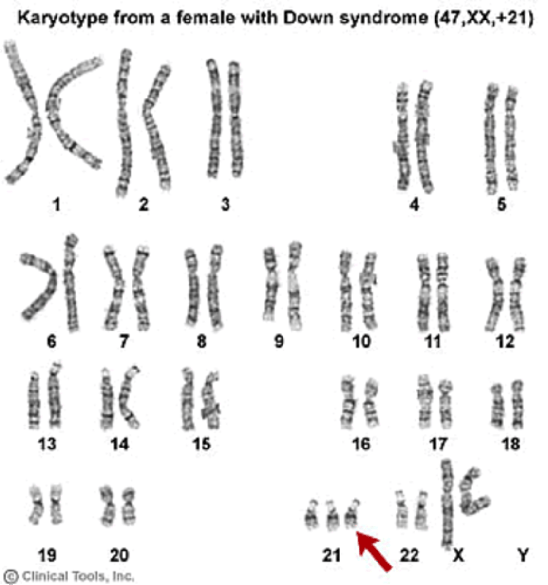 <p>Down Syndrome</p>