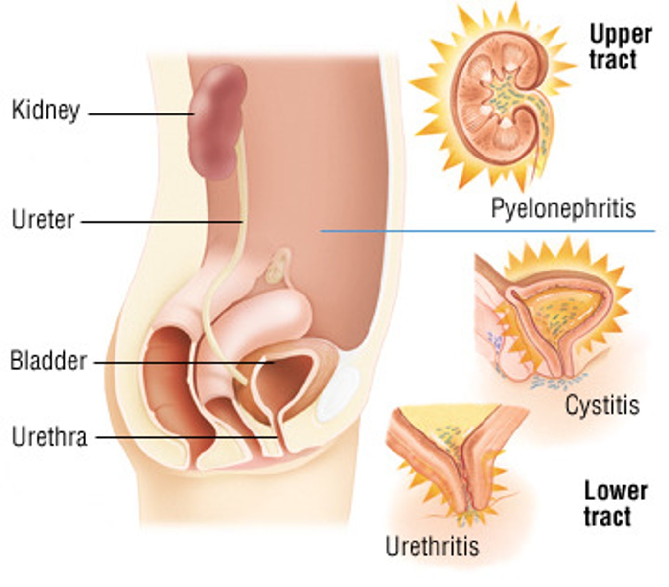 <p>• Inflammation of the urinary epithelium.</p><p>-In the bladder: acute cystitis (UTI)</p><p>- Pyelonephritis</p><p>• RF: elderly ( incontinence, poor hygiene), women (shorter urethra), pregnancy ( pH changes to be more alkalotic, and we need a little bit of acidity to kill bacteria), diabetes (sugar - bug love it)</p><p>• Symptoms: burning, urgency, frequency, dysuria (pain), possible to get a low grade fever with UTI and high fever with pyelonephritis, groin pain with UTI, with pyelonephritis will be flank pain, hematuria, only pee a little</p><p>• Tx: antibiotics, if you catch it early (cranberry juice can change acidity and kill bacteria), important to tell pt. to take prescription for entire time (if don't, you don't kill all of the bacteria, resistance will build so will need a stronger antibiotic)</p><p>• Elderly: even though most at risk are typically asymptomatic but they get confused, they wont experience all the dramatic symptoms, get mistake for symptoms of aging (dementia, etc)</p><p>• Complications: when elderly get a UTI, they can die from that one infection because they didn't get tx when they should have, but the infection that started in the bladder makes it way up to kidneys (pyelonephritis) more dangerous, kidney's have direct blood supply so once bacteria is there then bacteria can go into blood stream (sepsis)</p><p>• Pyelonephritis: bacteria in kidney's, high fever, typically admitted in a hospital, IV, antibiotics, can potentially shut kidneys down temporarily</p><p>• Can get UTI's easily in a hospital from catheter's.</p>