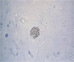<p>nephrotic syndrome</p>