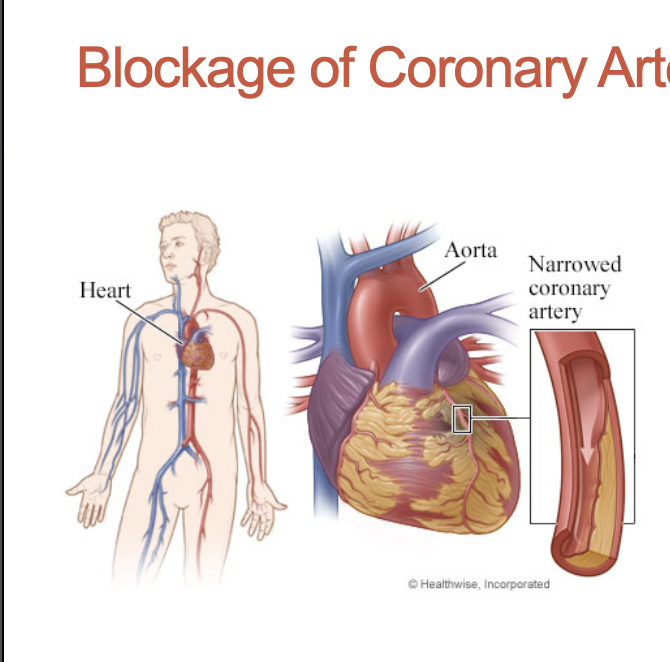 <p>What is the problem with blockages in coronary arteries? What part of the heart is most likely to be affected?</p>