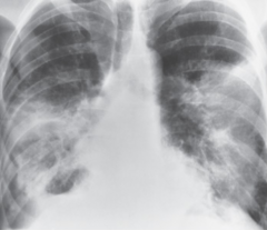 <p>This x-ray image indicates what pathology?</p>