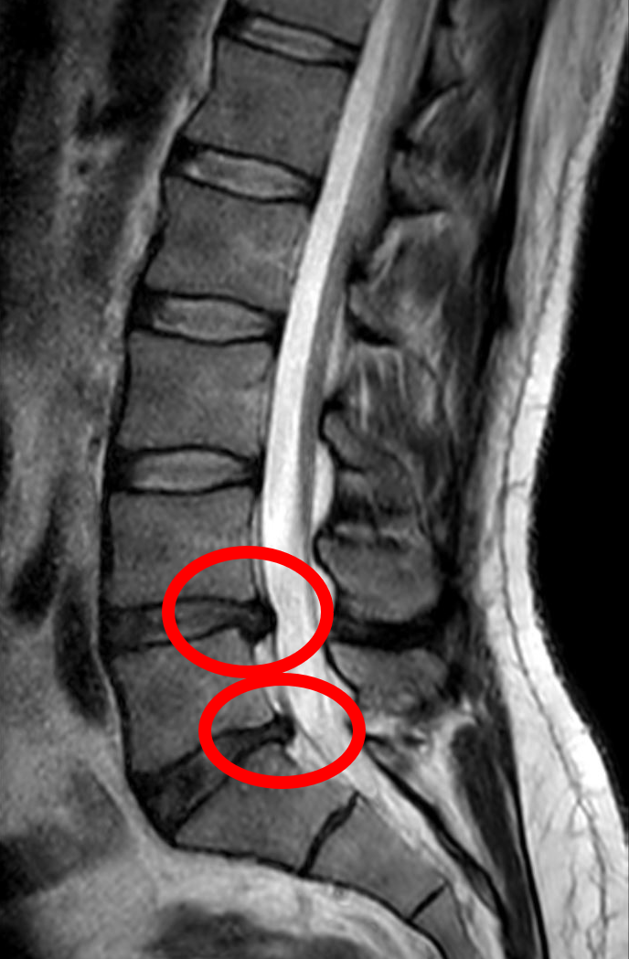 <p>Disc Herniation</p><ul><li><p>General Term for (<strong><em>localized) </em></strong>displacement of disc material > <strong>Nucleus Pulposus / Annulus Fibrosus</strong></p></li><li><p>Beyond Disc Space - Posterolatearlly - common at L4/L5 and L5/S1</p></li></ul><p></p>